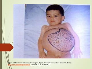 Figura 8: Menor apresentando esplenomegalia. Figura 7: Complicação da beta talassemia. Fonte:
http://www.googleimagens.com.br. Acesso em 14 de fev. de 2014.

 