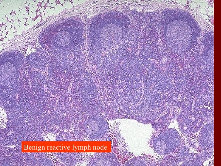 Slides of lymphoma and metastasis