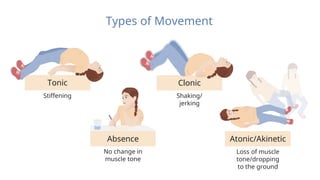 Atonic/Akinetic
Loss of muscle
tone/dropping
to the ground
Types of Movement
Absence
No change in
muscle tone
Clonic
Shaking/
jerking
Tonic
Stiffening
 