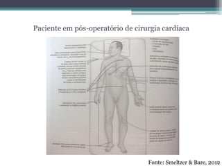 Paciente em pós-operatório de cirurgia cardíaca
Fonte: Smeltzer & Bare, 2012
 