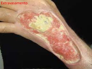 Extravasamento
Extravasamento
 