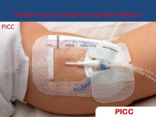 Cateter Venoso Central de Inserção Periférica
PICC
 