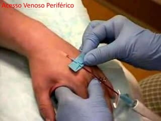 Acesso Venoso Periférico
 