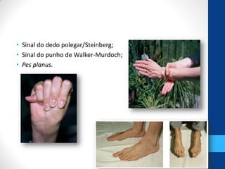 • Sinal do dedo polegar/Steinberg;
• Sinal do punho de Walker-Murdoch;
• Pes planus.
 
