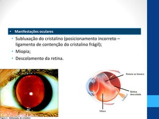 • subluxação do cristalino, miopia e descolamento
• Subluxação do cristalino (posicionamento incorreto –
ligamento de contenção do cristalino frágil);
• Miopia;
• Descolamento da retina.
• Manifestações oculares
 