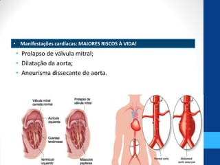 • Pprolapso de
• Prolapso de válvula mitral;
• Dilatação da aorta;
• Aneurisma dissecante de aorta.
• Manifestações cardíacas: MAIORES RISCOS À VIDA!
 