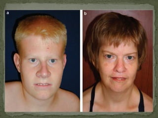 A síndrome de Prader-Willi foi
descrita primeiramente em
1956 em pacientes que
apresentavam:
 Atividade fetal diminuída
 Hipotonia infantil severa
 Problemas de alimentação
na infância
 Hipogonadismo e
hipogenitalismo
 Estatura baixa
 Mãos e pés pequenos
 Atraso no desenvolvimento
psicomotor
 Aparência facial
característica
 Retardo mental moderado
 Fome insasiável que levava a
um quadro de obesidade na
infância
 Problemas no
comportamento
 Tendência ao
desenvolvimento de
diabetes na adolescência.
 