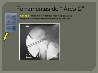 Ferramentas do “ Arco C”
Escopia: Imagens em tempo real, não salva as
imagens automaticamente, técnica automática.
 