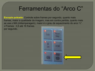 Ferramentas do “Arco C”
Escopia pulsada: Controle sobre frames por segundo, quanto mais
frames, maior a qualidade da imagem, mas em contra partida, quanto mais
se usa o MA (miliamperagem), maior é o grau de aquecimento do arco “c”.
Frames: 0,5 até 16 frames
por segundo.
 
