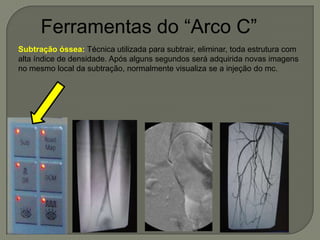 Ferramentas do “Arco C”
Subtração óssea: Técnica utilizada para subtrair, eliminar, toda estrutura com
alta índice de densidade. Após alguns segundos será adquirida novas imagens
no mesmo local da subtração, normalmente visualiza se a injeção do mc.
 