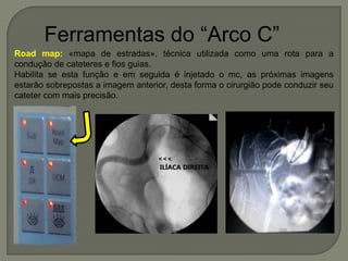 Ferramentas do “Arco C”
Road map: «mapa de estradas», técnica utilizada como uma rota para a
condução de cateteres e fios guias.
Habilita se esta função e em seguida é injetado o mc, as próximas imagens
estarão sobrepostas a imagem anterior, desta forma o cirurgião pode conduzir seu
cateter com mais precisão.
 
