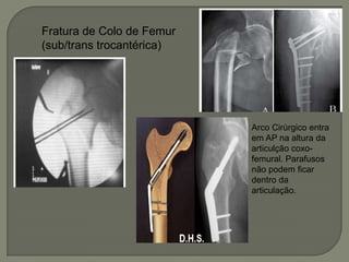 Fratura de Colo de Femur
(sub/trans trocantérica)
Arco Cirúrgico entra
em AP na altura da
articulção coxo-
femural. Parafusos
não podem ficar
dentro da
articulação.
 