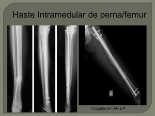 Haste Intramedular de perna/femur
Imagens em AP e P
 