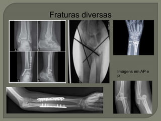Fraturas diversas
Imagens em AP e
P
 