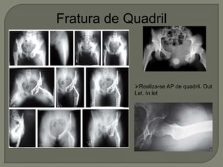 Fratura de Quadril
Realiza-se AP de quadril. Out
Let. In let
 