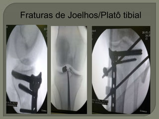 Fraturas de Joelhos/Platô tibial
 