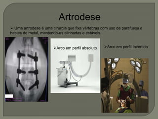 Artrodese
 Uma artrodese é uma cirurgia que fixa vértebras com uso de parafusos e
hastes de metal, mantendo-as alinhadas e estáveis.
Arco em perfil absoluto Arco em perfil Invertido
 