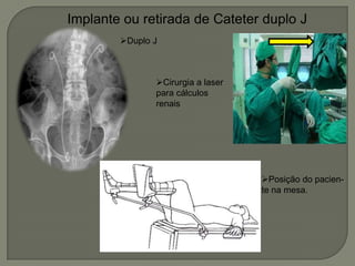 Implante ou retirada de Cateter duplo J
Duplo J
Cirurgia a laser
para cálculos
renais
Posição do pacien-
te na mesa.
 