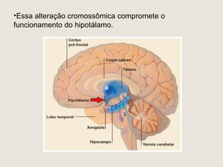 •Essa alteração cromossômica compromete o
funcionamento do hipotálamo.
 