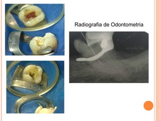 Radiografia de Odontometria
 