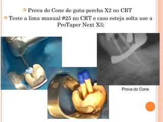  Lima ProTaper Next X3 + NaOCl no CRT
 Prova do Cone de guta-percha X3 no CRT
Prova do Cone
 