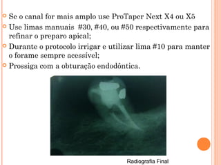 Prossiga com a obturação endodôntica pela Condensação
Vertical com Cone Único.
Radiografia Final
Obs.: Se o canal for mais amplo use ProTaper Next X4 ou X5
Use limas manuais #30, #40, ou #50 respectivamente para refinar o
preparo apical;
 
