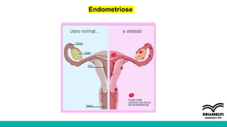 Endometriose
 