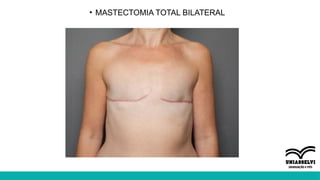• MASTECTOMIA TOTAL BILATERAL
 