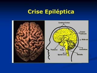 Crise Epiléptica
 