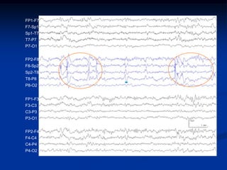 FP1-F7
F7-Sp1
Sp1-T7
T7-P7
P7-O1


FP2-F8
F8-Sp2
Sp2-T8
T8-P8
P8-O2


FP1-F3
F3-C3
C3-P3
P3-O1


FP2-F4
F4-C4
C4-P4
P4-O2
 