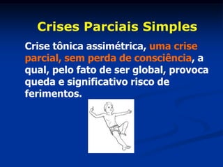 Crises Parciais Simples
Crise tônica assimétrica, uma crise
parcial, sem perda de consciência, a
qual, pelo fato de ser global, provoca
queda e significativo risco de
ferimentos.
 