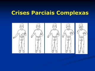 Crises Parciais Complexas
 