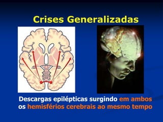 Crises Generalizadas




Descargas epilépticas surgindo em ambos
os hemisférios cerebrais ao mesmo tempo
 
