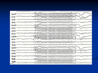FP1-F7
F7-T7
T7-P7
P7-O1

FP1-F3
F3-C3
C3-P3
P3-O1
Fp2-F8
F8-T8
T8-P8
P8-O2

FP2-F4
F4-C4
C4-P4
P4-O2
 