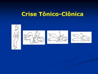Crise Tônico-Clônica
 