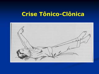 Crise Tônico-Clônica
 