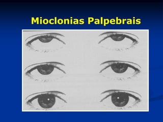 Mioclonias Palpebrais
 