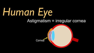 Astigmatism = irregular cornea
 