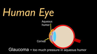 Glaucoma = too much pressure in aqueous humor
 