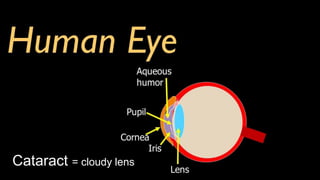 Cataract = cloudy lens
 