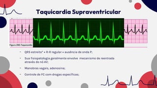 - QRS estreito* + R-R regular + ausência de onda P;
- Sua fisiopatologia geralmente envolve mecanismo de reentrada
através do nó AV;
- Manobras vagais, adenosina;
- Controle de FC com drogas específicas;
Taquicardia Supraventricular
 