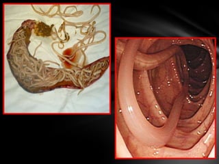 Tênias e teníases - Ascaridíase 