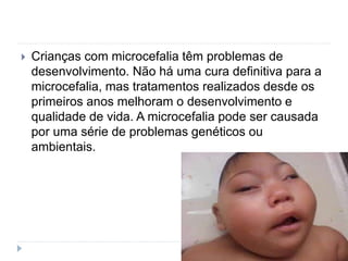  Crianças com microcefalia têm problemas de
desenvolvimento. Não há uma cura definitiva para a
microcefalia, mas tratamentos realizados desde os
primeiros anos melhoram o desenvolvimento e
qualidade de vida. A microcefalia pode ser causada
por uma série de problemas genéticos ou
ambientais.
 