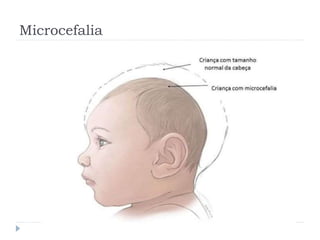 Microcefalia
 