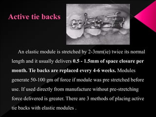 An elastic module is stretched by 2-3mm(ie) twice its normal
length and it usually delivers 0.5 - 1.5mm of space closure per
month. Tie backs are replaced every 4-6 weeks. Modules
generate 50-100 gm of force if module was pre stretched before
use. If used directly from manufacture without pre-stretching
force delivered is greater. There are 3 methods of placing active
tie backs with elastic modules .
 