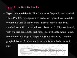  Type 1: active tiebacks. This is the most frequently used method.
The .019x .025 rectangular steel archwire is placed, with modules
or wire ligatures on all brackets. The elastomeric module is
attached to the first or second molar hook. A .010 ligature is used,
with one arm beneath the archwire. This makes the active tieback
more stable, and helps to keep the ligature wire away from the
gingival tissues. An elastomeric module is stretched to twice its
size.
 