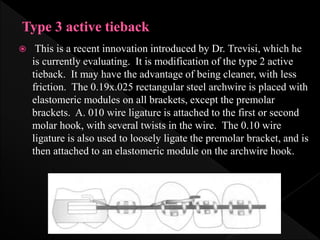  This is a recent innovation introduced by Dr. Trevisi, which he
is currently evaluating. It is modification of the type 2 active
tieback. It may have the advantage of being cleaner, with less
friction. The 0.19x.025 rectangular steel archwire is placed with
elastomeric modules on all brackets, except the premolar
brackets. A. 010 wire ligature is attached to the first or second
molar hook, with several twists in the wire. The 0.10 wire
ligature is also used to loosely ligate the premolar bracket, and is
then attached to an elastomeric module on the archwire hook.
 