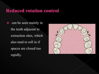  can be seen mainly in
the teeth adjacent to
extraction sites, which
also tend to roll in if
spaces are closed too
rapidly.
 