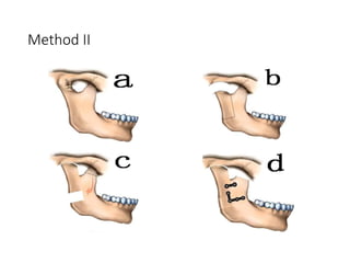 Condyle Lift SLIDING RECONSTRUCTION OF THE CONDYLE USING POSTERIOR BORDER.pptx