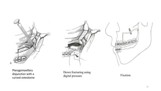 Suparma File Surgery slidsahre-file orthognathic surgery (1).pptx